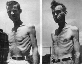 Two shirtless emaciated men during the Minnesota Starvation Experiment